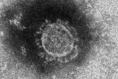 新型コロナ、重症者ほど後遺症発症の割合高まる　独協医科大