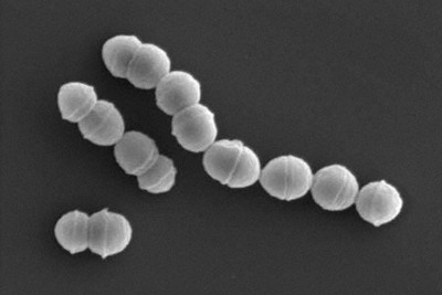 劇症型溶連菌、患者過去最多に　半年で977人、致死率3～7割