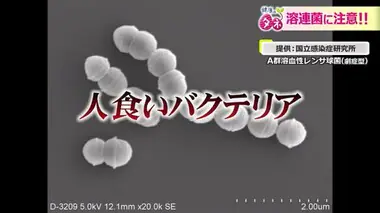 「夏の三大風邪」流行ピーク期に　早期発見がカギの「劇症型溶血性レンサ球菌」も増加傾向　対策を聞いた