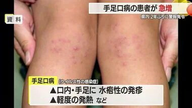 【山形】手足口病の患者急増・国の基準超え2年ぶり「警報」発令　こまめな手洗い徹底し予防を