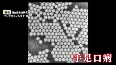 1シーズンに3回感染も？手足口病　5年ぶりの大流行は“枯れ木に火がついたような”状況　大人が重症化する理由は